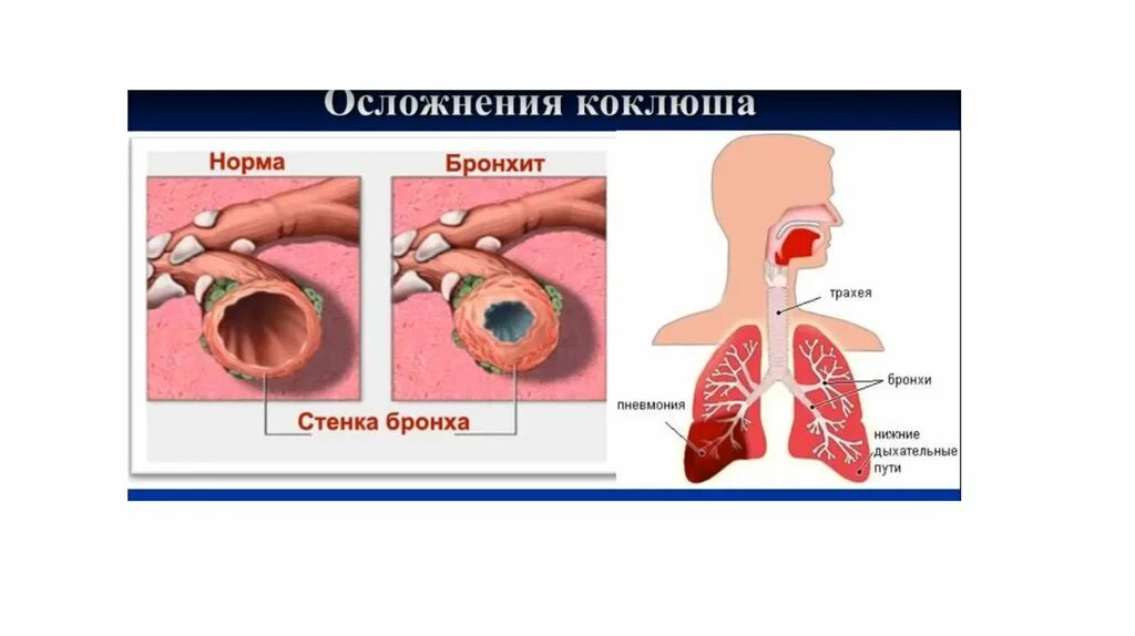 Легкие при коклюше. Осложнения коклюша картинки.