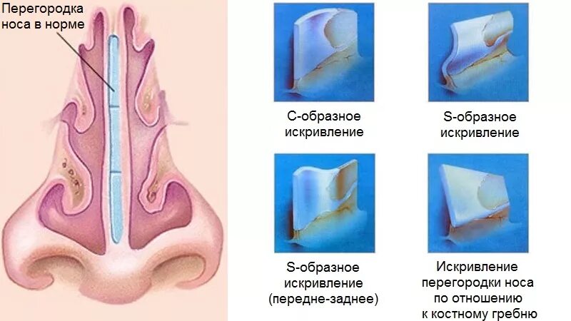 Лазер слизистой носа. Анатомия искривлённой носовой перегородки. Смещение, хряща, носовой перегородки.. Костный шип перегородки носа. Носовая перегородка:костно-хрящевая ткань?.