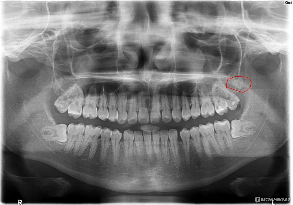 Снимок зубов видное. Ортопантомограмма зубы мудрости. Ортопантомограмма челюсти.