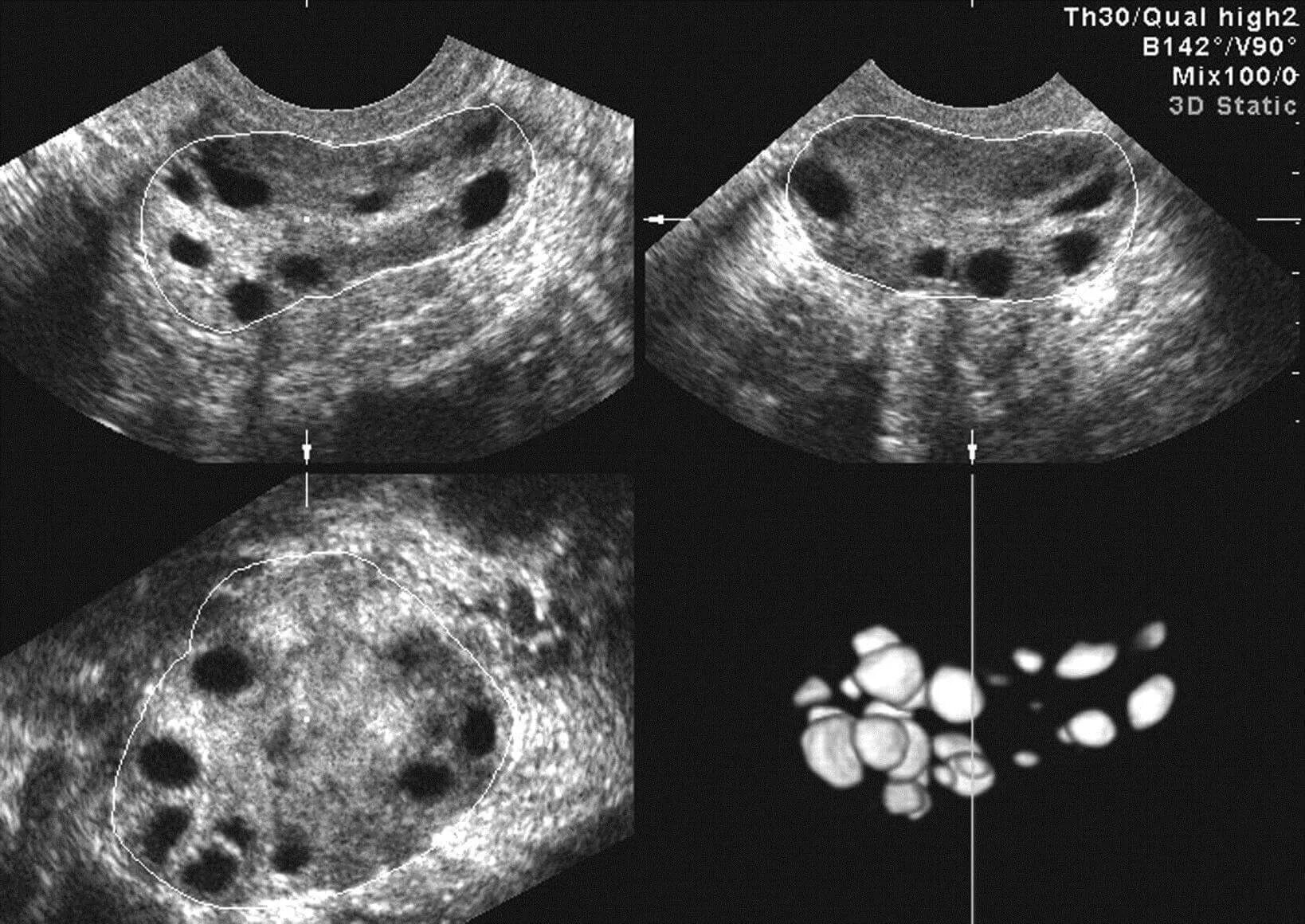 Синдром Штейна-Левенталя (поликистоз яичников). Поликистоз матки яичников УЗИ. Синдром поликистозных яичников УЗИ. Мфя в гинекологии что