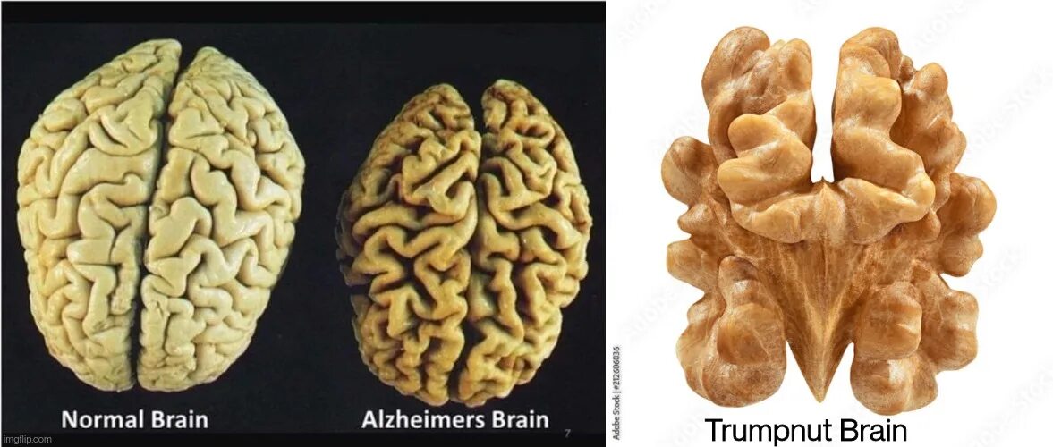 Brain vs brain. Болезнь Альцгеймера. Мозг пьющего и здорового рисунок. Сравнение мозга обычного человека и алкоголика.