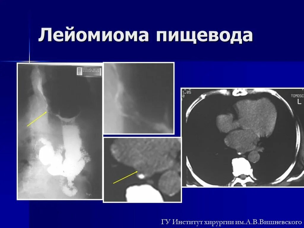 Кт пищевода и желудка. Лейомиома желудка рентгенодиагностика. Рентген лейомиомы пищевода. Лейомиома пищевода кт признаки.