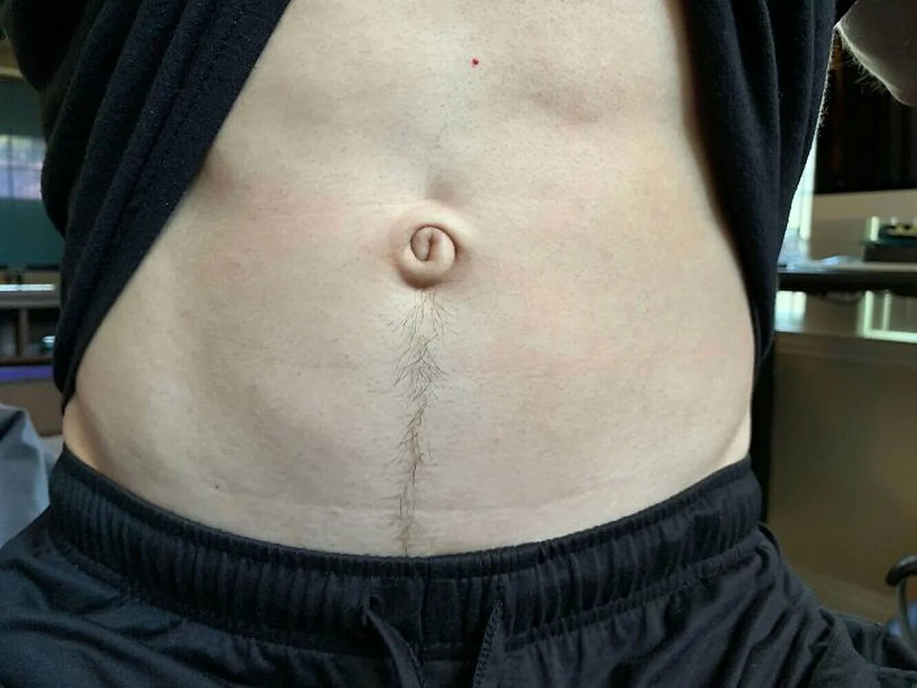 Пуп 3. Outie belly button Ивана Петрова.