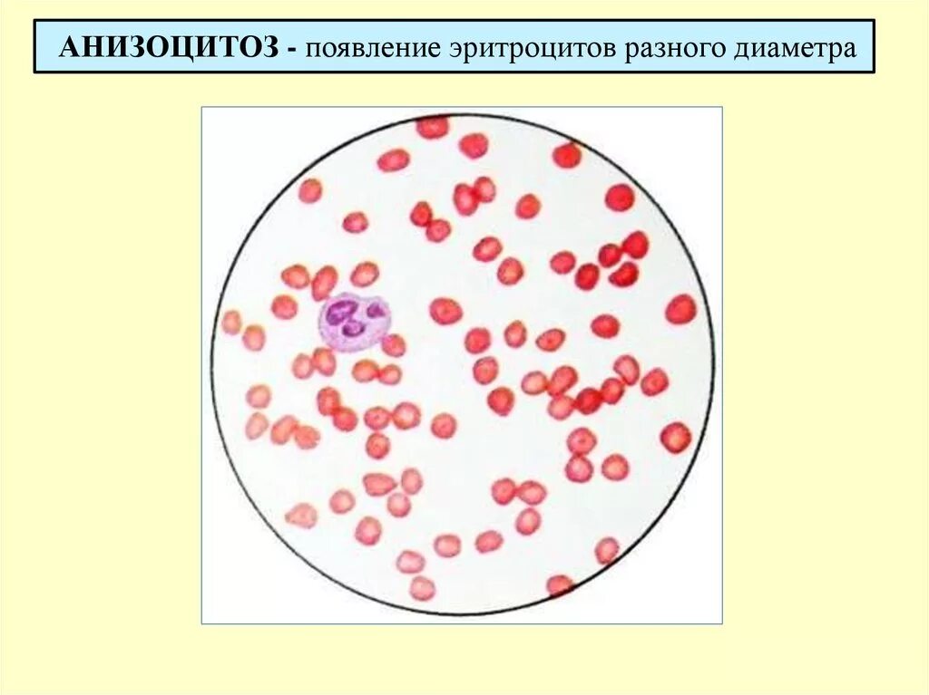 Эритроциты 5 5 у мужчин. Гипохромия анизоцитоз эритроцитов что это такое. Анизоцитоз,макроцитоз,пойкилоцитоз, гипохромия. Анизоцитоз пойкилоцитоз гипохромия. Гипохромная анемия. Анизоцитоз эритроцитов.