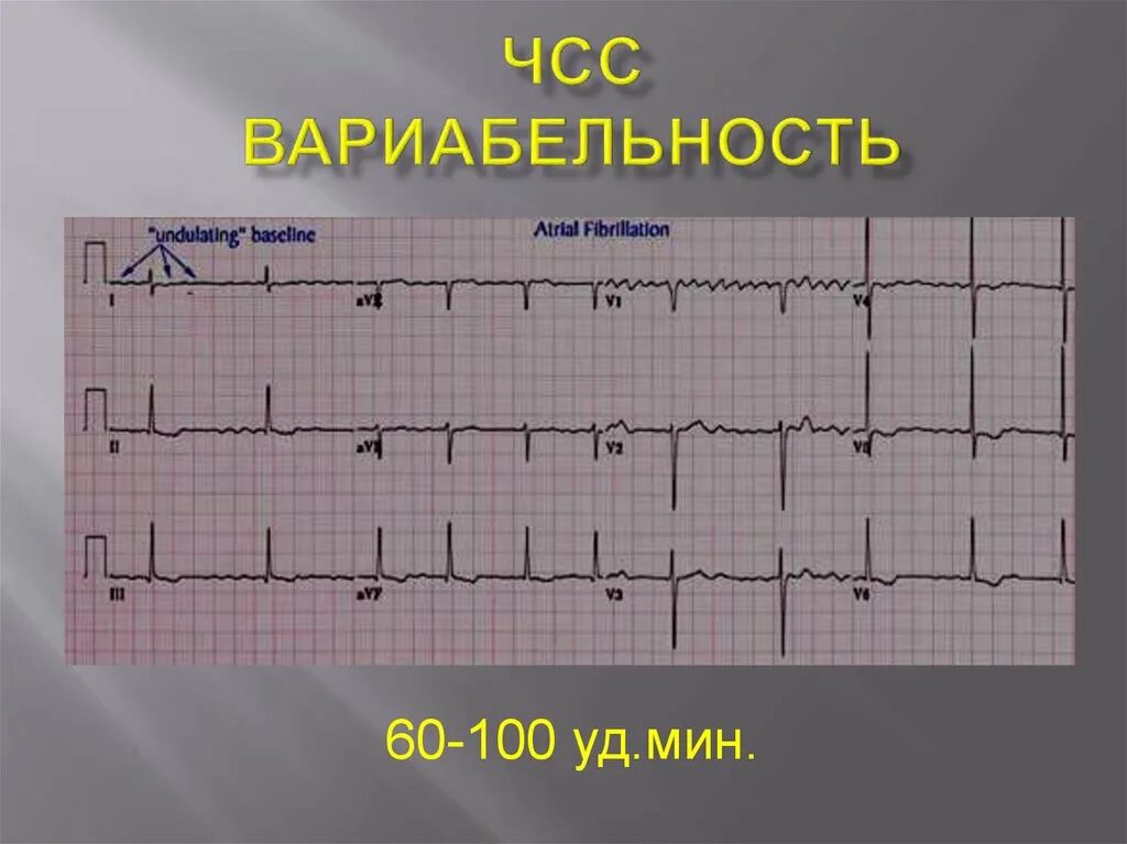 Нормы частоты сердечных сокращений таблица. Синусовый ритм сердца норма. Экг расшифровка. Ушки на экг. Нормы экг у детей таблица.
