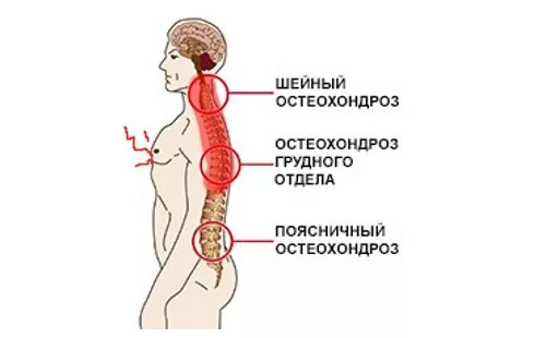 Симптомы остеохондроза у женщин форум. Локализация остеохондроза. Локализация боли при остеохондрозе. Грудной остеохондроз. Локализация боли при грудном остеохондрозе.