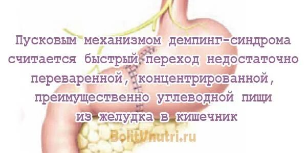 Демпинг синдром после резекции желудка. Демпинг синдром после резекции. синдром после резекции желудка. демпинг желудка синдром после резекции синдром.