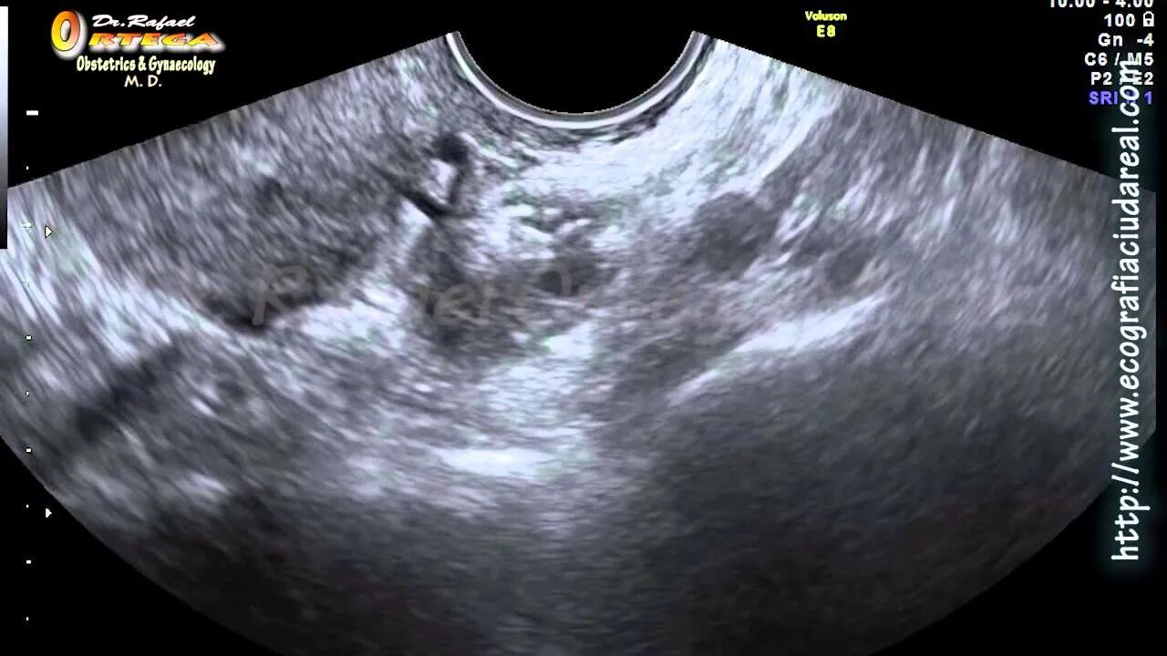 миома 6 7 недель