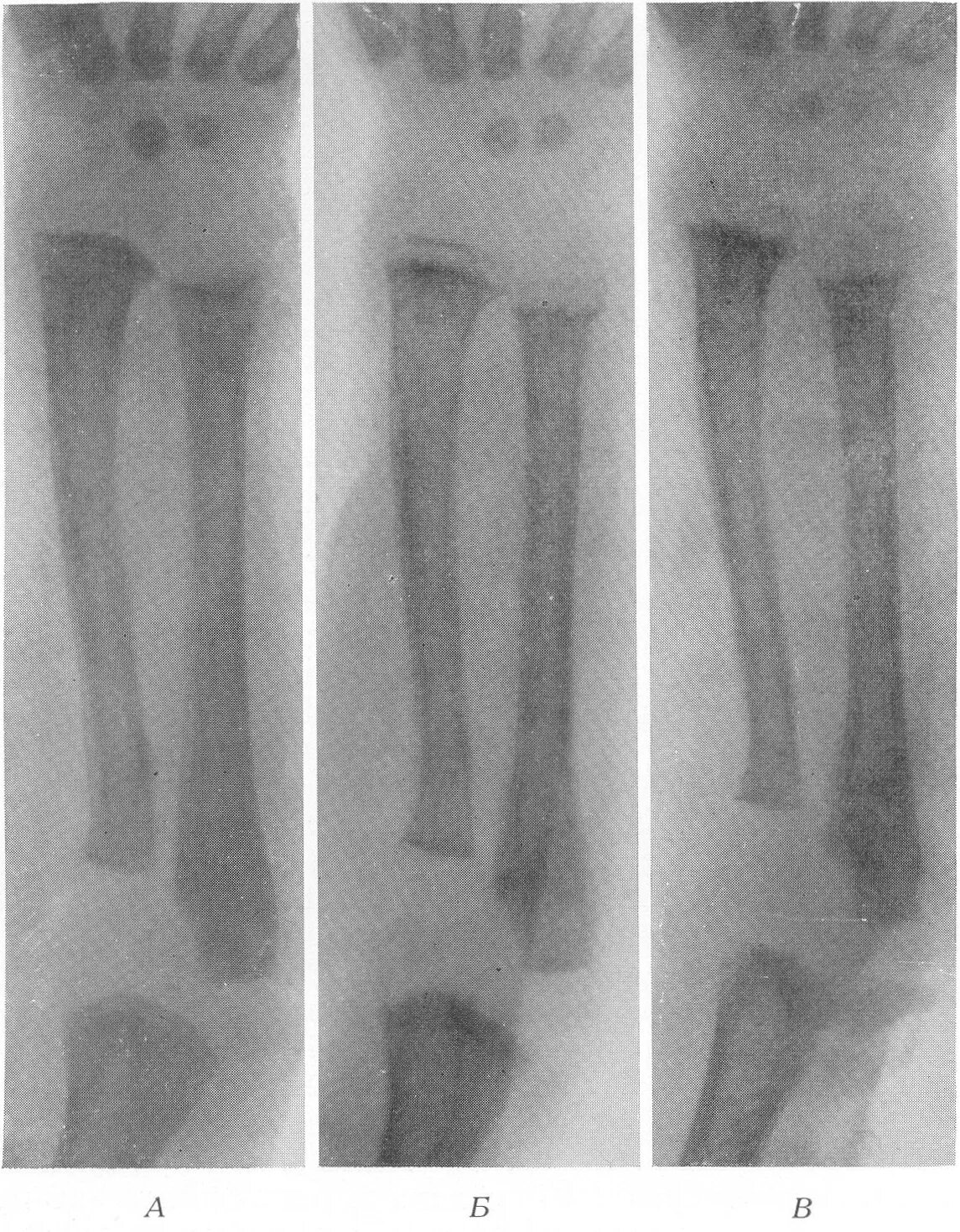 Укорочение трубчатых костей. Рахит снимок рентгенограмма. Рентгенограмма рахит костей. Рентген трубчатых костей при рахите. Рентгенологическая картина рахита.