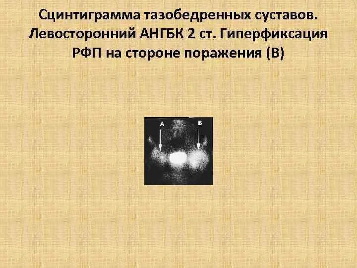 Теория гиперфиксации. Очаг гиперфиксации рфп что это. гиперфиксация рфп что это такое. очаги патологической гиперфиксации рфп в костях что это такое. сцинтиграмма.