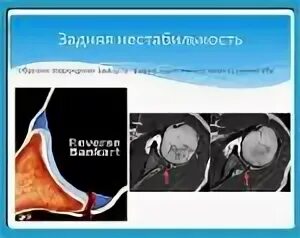 Повреждение суставной губы. Разрыв суставной губы лопатки.