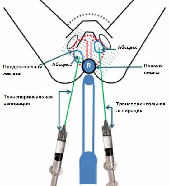 Сколько длится простата. Лазерная резекция простаты схема. Лазерная операция аденомы простаты. Подготовка к операции предстательной железы.