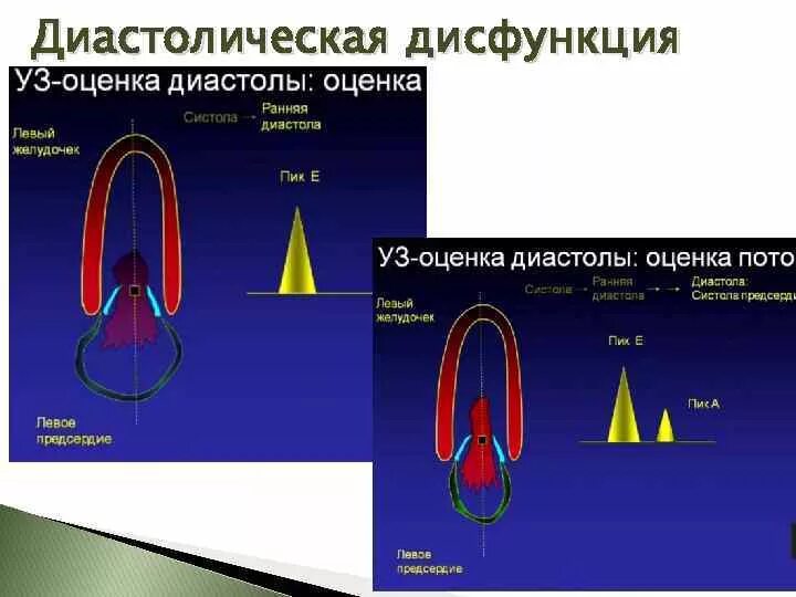 Диастолическая функция миокарда. Диастолическая дисфункция лж 2 типа. Диастолическая дисфункция левого желудочка. Диастолическая дисфункция на ЭХОКГ.