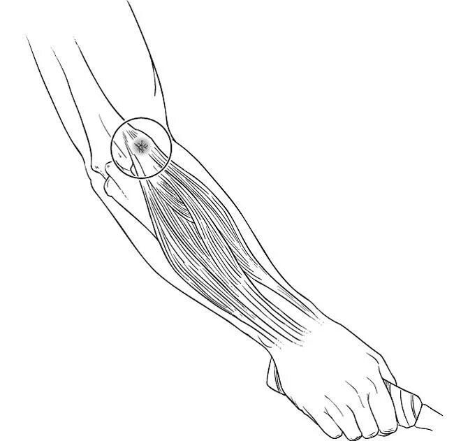Лечение предплечья. Эпикондилит предплечья. Латеральный эпикондилит анатомия. Эпикондилит плеча клиника.