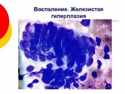Пролиферация железистого эпителия nilm