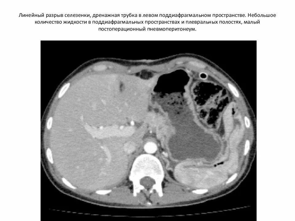 Подкапсульная гематома селезенки на кт. Подкапсульные гематомы печени кт. Подкапсульный разрыв печени кт. Распад селезенки