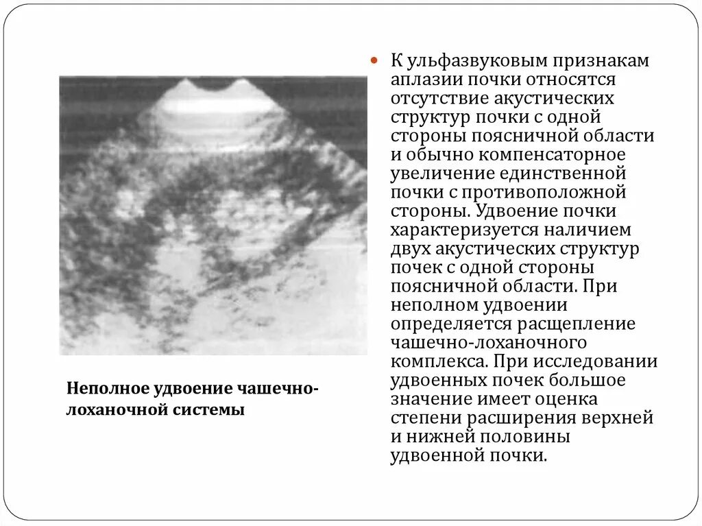 Признаки удвоения почки на УЗИ. Удвоение ЧЛС почек на УЗИ признаки. Удвоение чашечно-лоханочной системы почек. Неполное удвоение чашечно лоханочной системы почки.