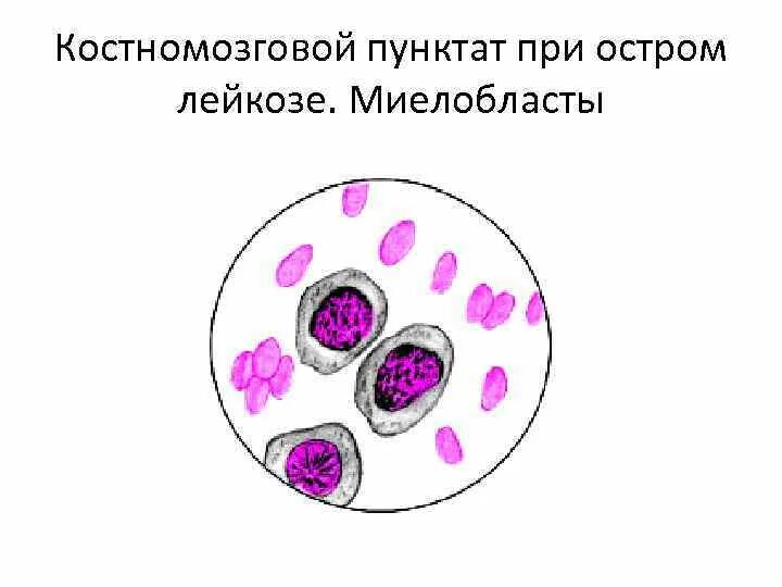 Острый лейкоз миелограмма. Костномозговой пунктат. Острый миелолейкоз миелограмма. Миелограмма при остром миелолейкозе.