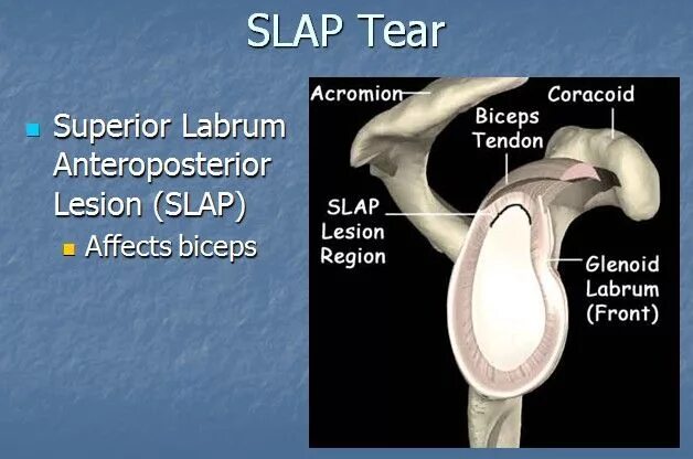 Slap повреждение плечевого сустава. Slap разрыв классификация.