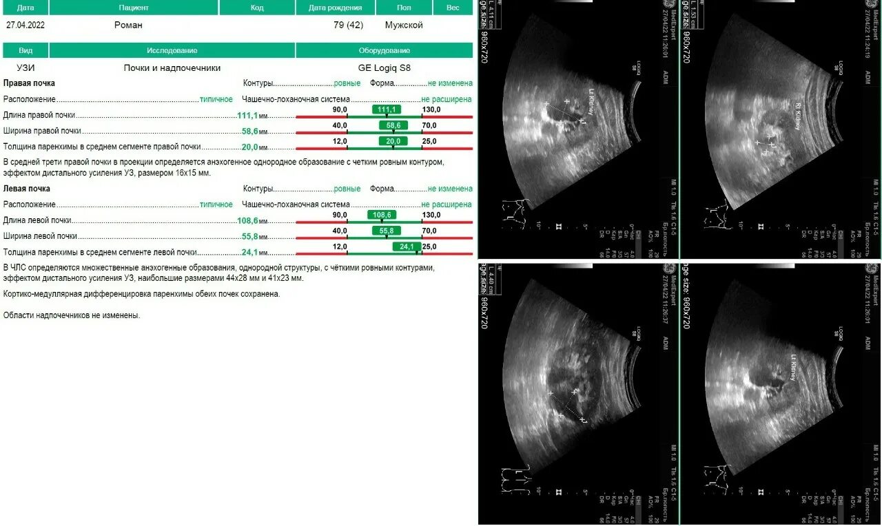 Расширенная члс. Расширение ЧЛС по УЗИ. Расширение чашечно-лоханочной системы почек на УЗИ. Расширение чашечно лоханочной системы по УЗИ. Расположение кист почек на УЗИ.