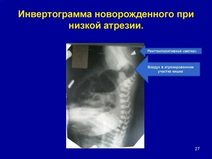 Аноректальные пороки у детей
