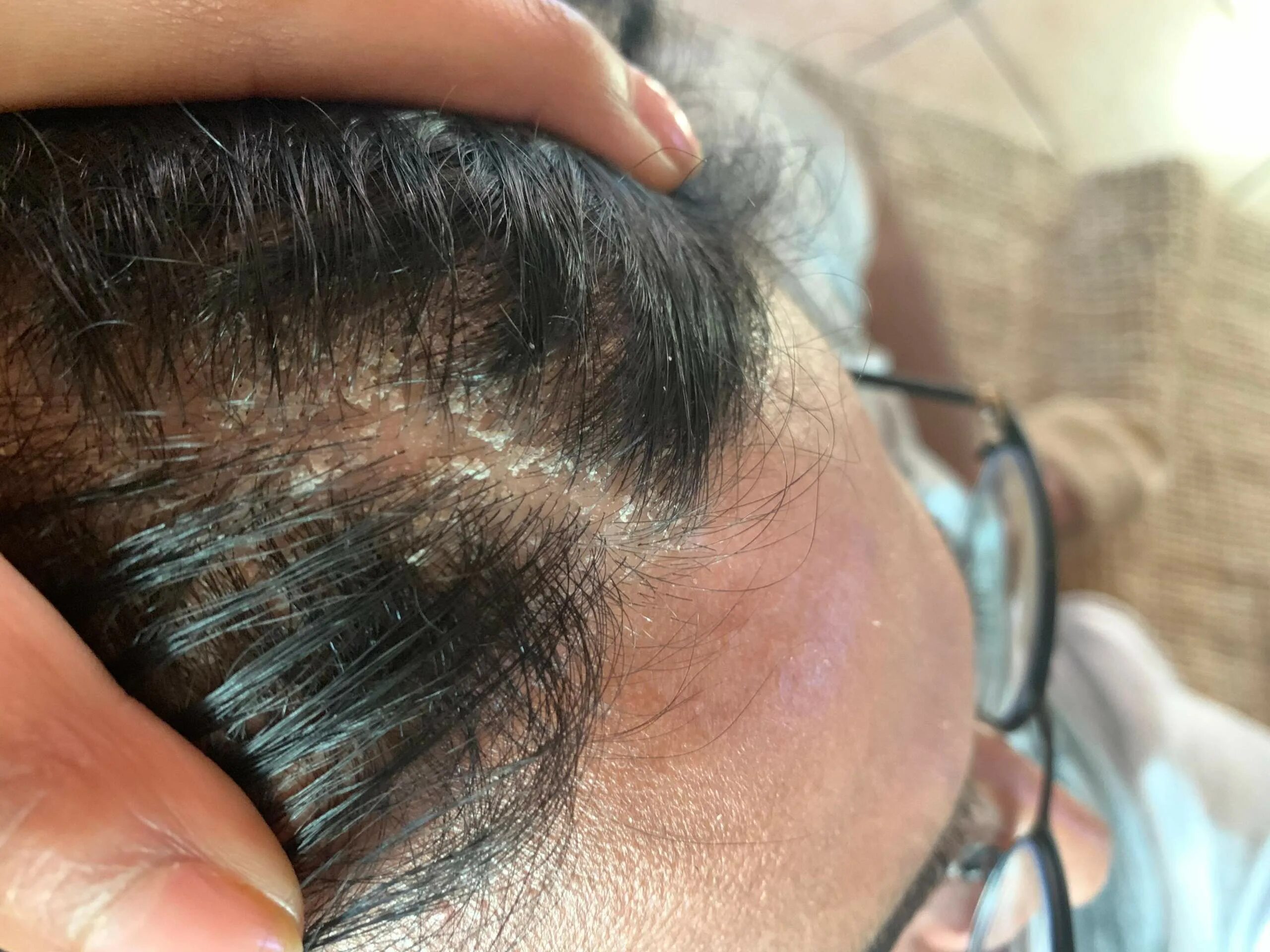 Обработка головы при гнейсе. Гнейс атопический дерматит. Себорейный дерматит у новорожденного. Обработка глаз новорожденного. Себорейные корочки на голове у грудничка.