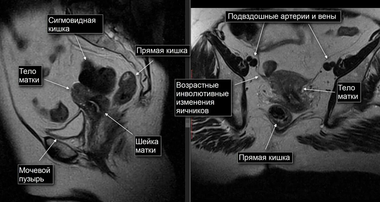 Кт анатомия малого таза у женщин. Мрт органов малого таза у женщин. Мрт анатомия малого таза женщины. Малый таз мрт анатомия.