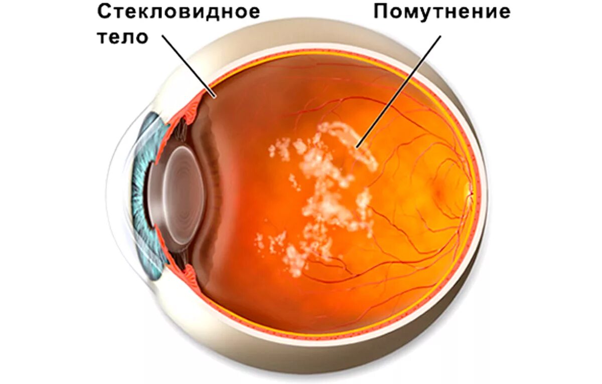 Витреолизис стекловидного тела. Деструкция стекловидного тела биомикроскопия. Нитчатая деструкция стекловидного тела. Деструкция стекловидного тела глаза. Прозрачное тело в глазу