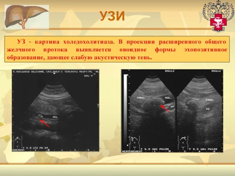 Образование без акустической тени. Холедохолитиаз на УЗИ. Холедохолитиаз УЗИ протокол. Холедохолитиаз УЗИ заключение. Холедохолитиаз УЗИ признаки.