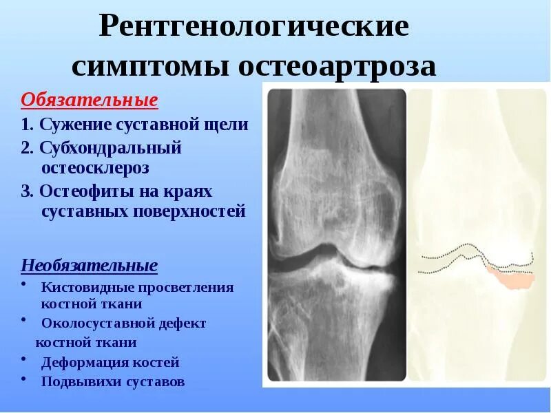 Субхондральная кость тазобедренного сустава. Субхондральной костной ткани. Деформирующий остеоартроз локтевого сустава рентген. Субхондральной костной ткани. Субхондральная пластинка бедренной кости.