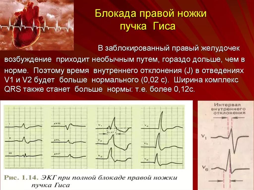 Что значит полная блокада. ЭКГ полная блокада правой ножки п.Гиса. ЭКГ полная блокада правой ножки пучка. Блокада левой ножки пучка Гиса клиника. Блок правой ножки пучка Гиса.