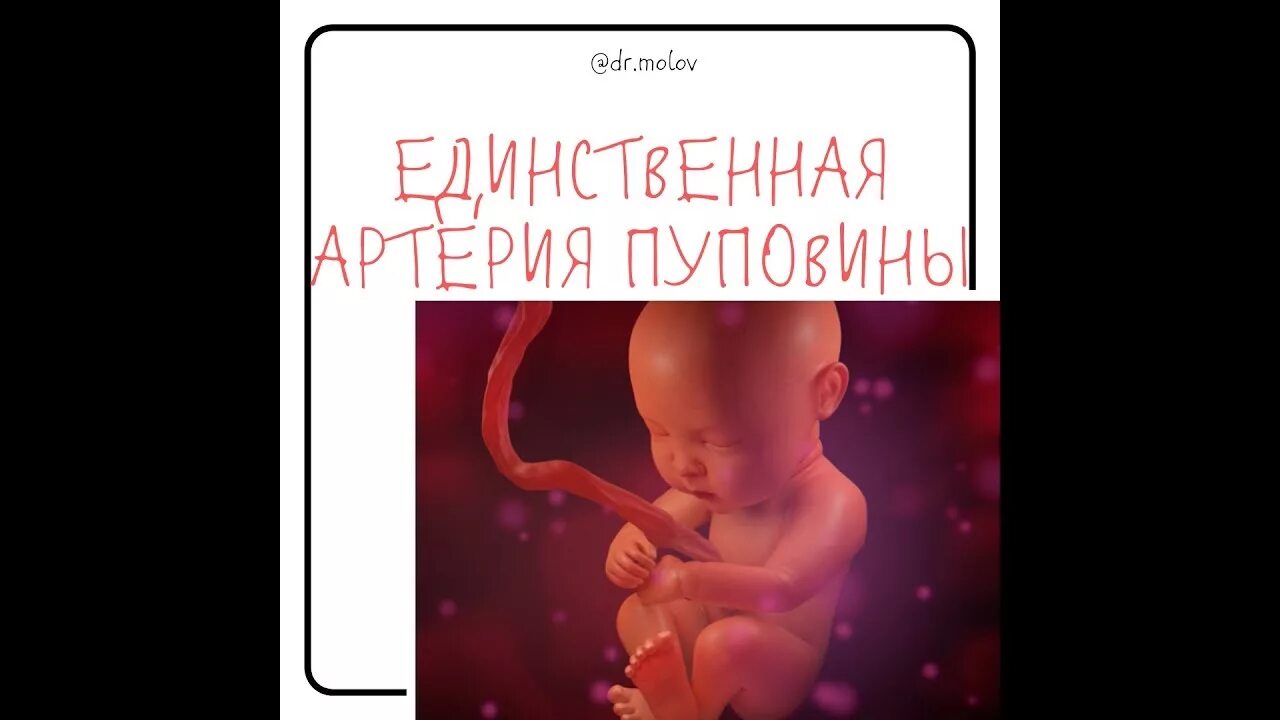 Нулевой кровоток в артерии пуповины. Единственная артерия пуповины при беременности. Артерия пуповины что это. Строение пупочного канатика гистология. Нарушение гемодинамики в артерии пуповины.
