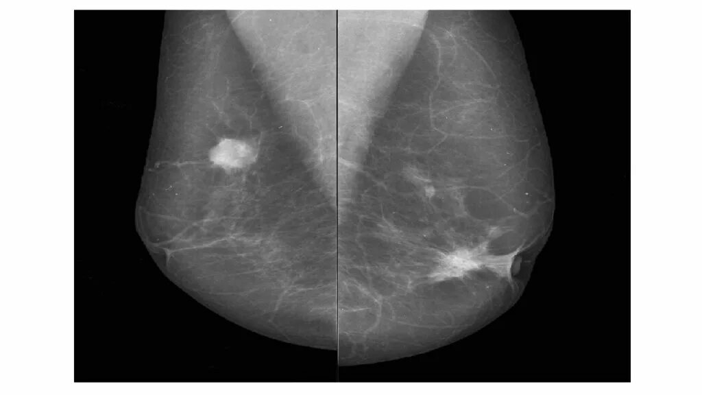 Округлые образования в молочной железе