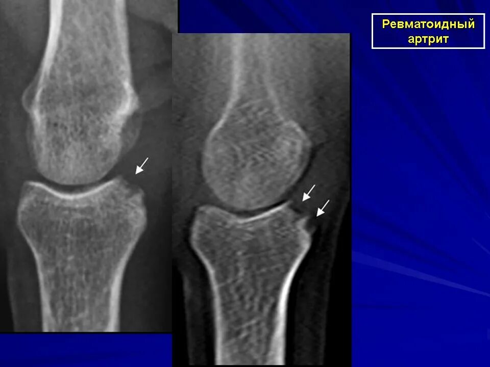 Артрит кт. Ювенильный артрит коленного сустава рентген. Остеопороз коленного сустава рентген. Ревматоидный артрит рентген суставов.