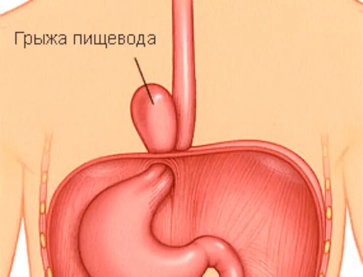 Купить пищевод. Грыжа пищеводного отверстия пищевода симптомы. Грыжа диафрагмального отверстия пищевода. Грыжа пищевод желудок диафрагмы. Грыжи пищеводного отверстия диафрагмы (ГПОД).