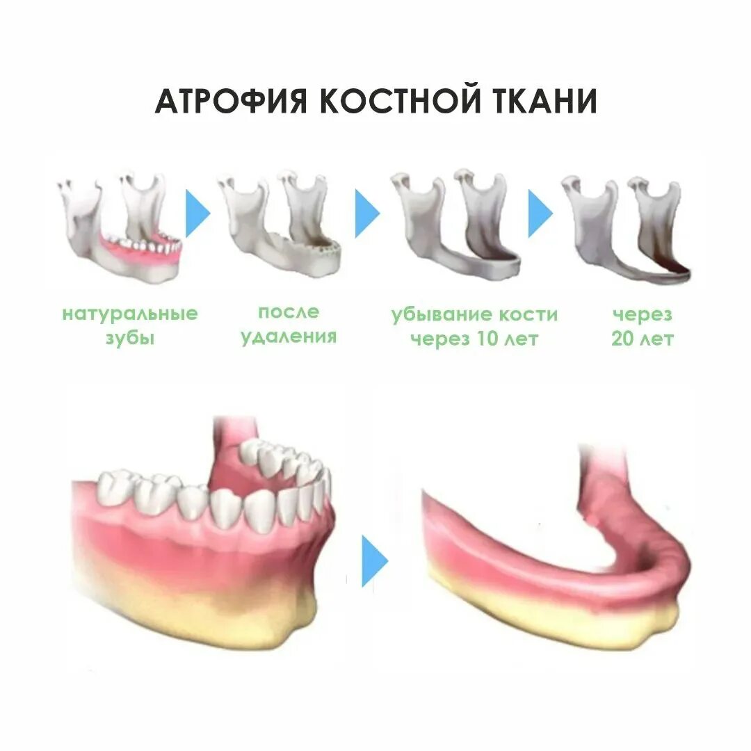 Через сколько можно вставить зубы