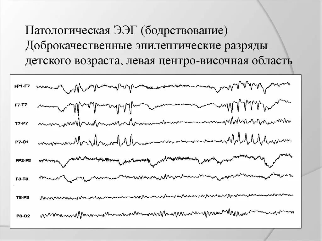 Активность ээг у ребенка что это. Эпилептиформные паттерны на ЭЭГ. Эпи паттерны на ЭЭГ. Доброкачественные эпилептиформные паттерны детства на ЭЭГ. Эпилептиформная активность на ЭЭГ У ребенка что это.