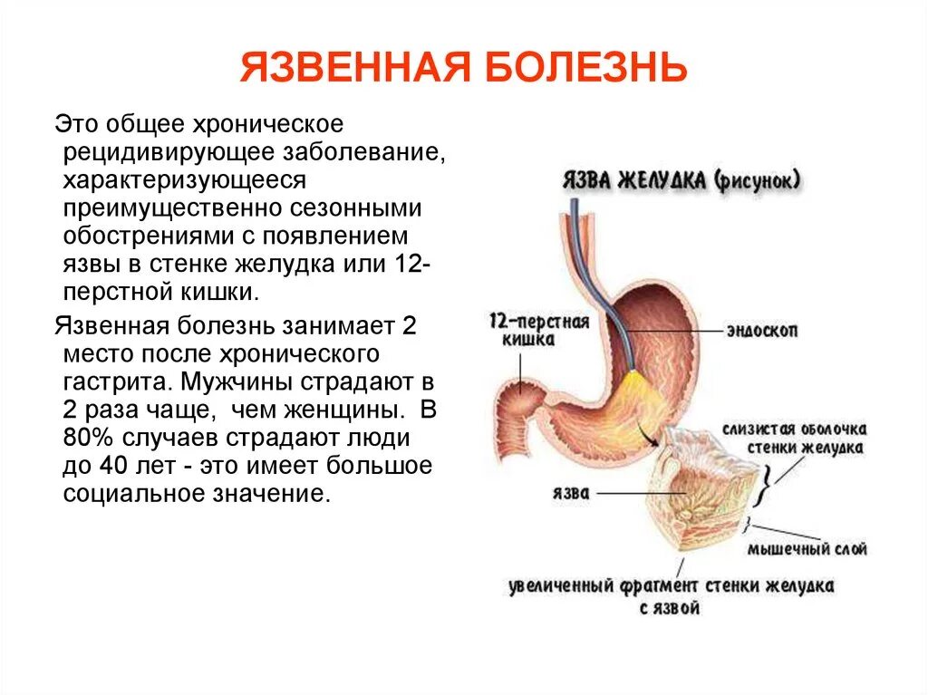 Возникновение язвы желудка. Положения, характерные для хронической язвы желудка. Язвенным болезнь желудка ЭТЛ. Заболевания желудка и двенадцатиперстной кишки.