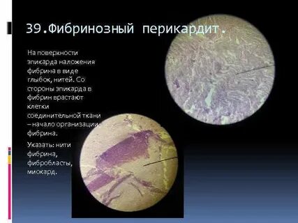 Фибринозный перикардит микропрепарат