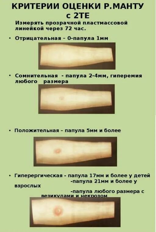 Положительный результат пробы. Туберкулиновая проба реакция манту у детей. Проба манту реакция положительная папула 10мм. Реакция манту у ребенка 3 года по дням. Оценка результатов туберкулинодиагностики диаскинтест.