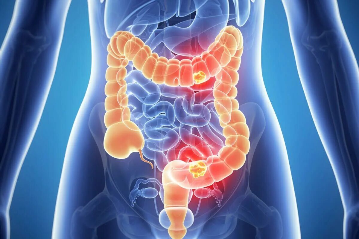 Раздутая толстая кишка. Метеоризм прямой кишки. Метеоризм кишечника причины и лечение у взрослых. Толстый кишечник вздутие. Метеоризм прямой кишки.