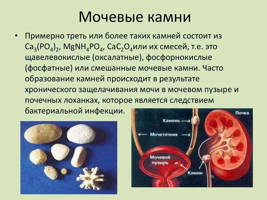 Камни в мочевом у мужчин лечение