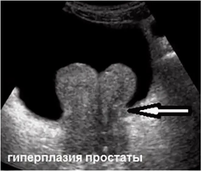 Трузи предстательной железы мочевого пузыря. Трансректальное УЗИ предстательной железы (+УЗИ мочевого пузыря. Снимки УЗИ аденомы простаты.