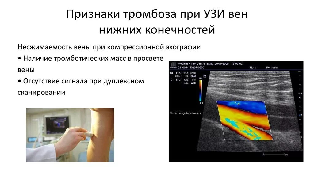 Тромбоз вен нижних конечностей УЗИ. Тромбоз глубоких вен нижних конечностей на УЗИ. УЗИ критерии тромбоза глубоких вен. Протокол ультразвуковая допплерография вен нижних конечностей. Признаки глубокого тромбоза