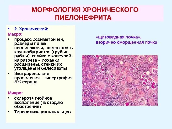 Морфологические изменения болезни. Пиелонефрит морфология патанатомия. Пиелонефрит: этиология патанатомия. Патоморфология подострого гломерулонефрита. Хронический пиелонефрит патологическая анатомия микропрепарат.