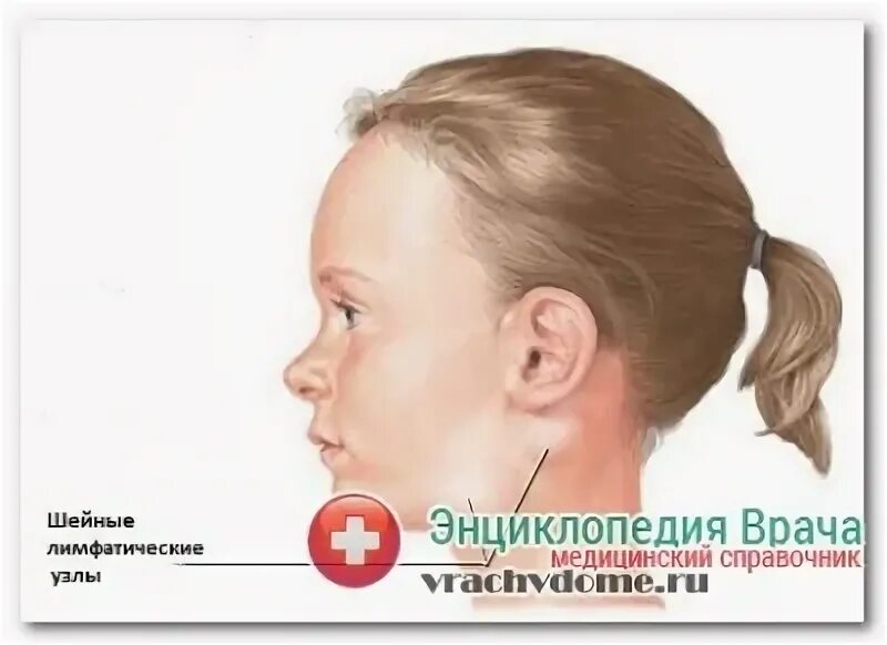 Подчелюстной лимфаденит код мкб. Подчелюстной лимфаденит мкб 10. околоушной лимфаденит мкб.