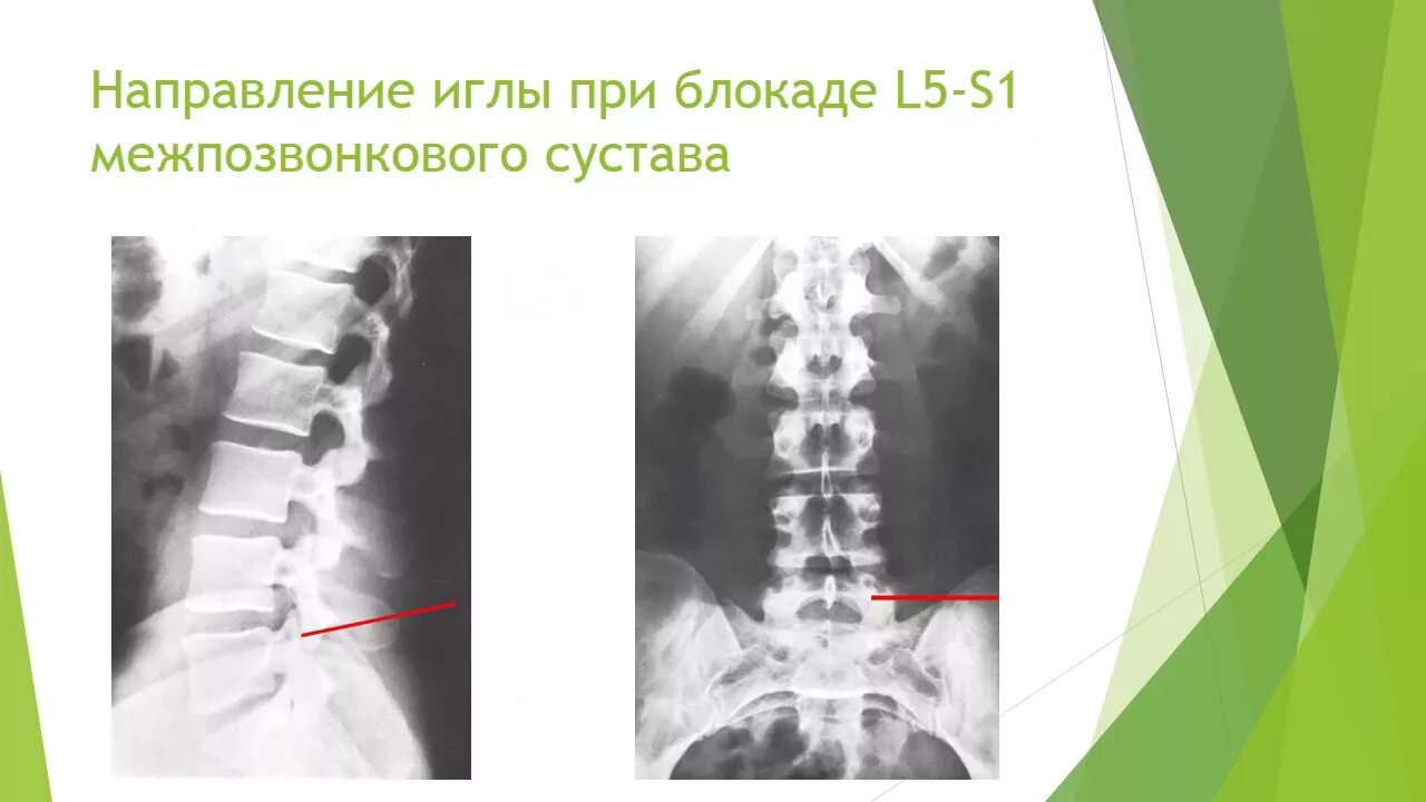 Блокада грыжи цена. Паравертебральные блокады поясничного отдела. Паравертебральная блокада (пояснично-крестцовый отдел) ГКС.. Блокада позвоночника при грыже.