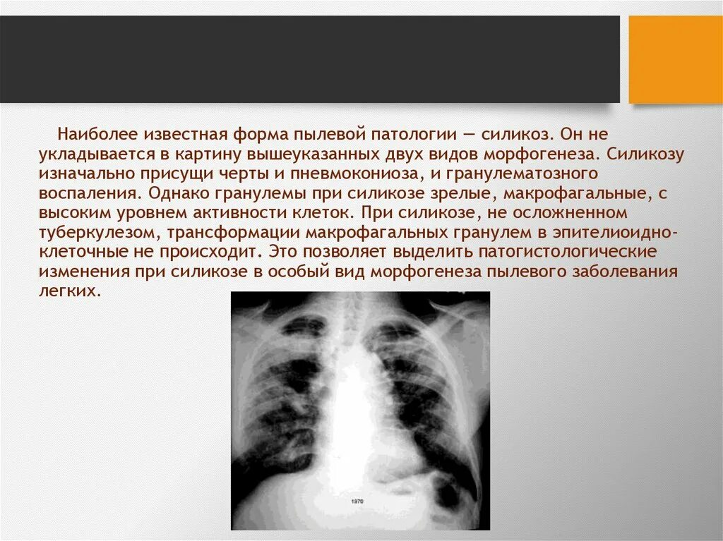 Болезнь легких силикоз. Силикоз легких что это симптомы лечение. Силикоз болезнь шахтеров. Силикоз легких что это симптомы лечение. Пневмокониоз макропрепарат.