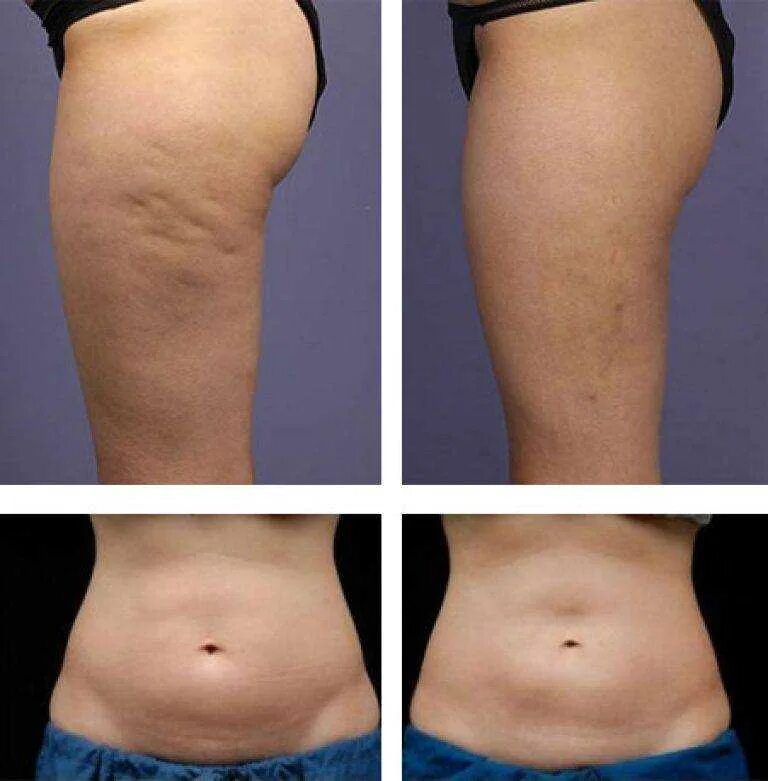 Lipolysis липолитик. Липолитики целлюлит до после. Липодистрофия целлюлит.