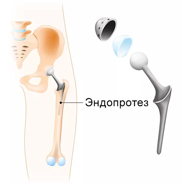 Тазобедренный сустав замена сколько ходить на костылях. Эндопротез тазобедренного сустава операция. Эндопротезирование левого тазобедренного сустава. Компоненты тотального эндопротеза тазобедренного сустава. Эндопротезирование ТБС операция.